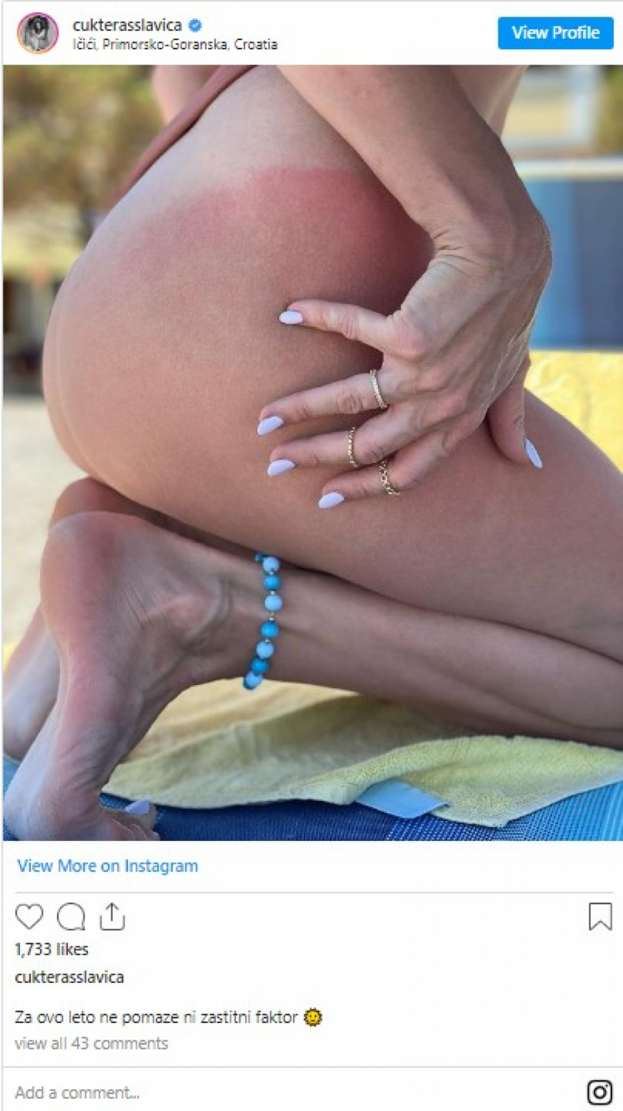 PRETERALA SA SUNČANJEM Slavica Ćukteraš objavila fotku sa opekotinama na intimnim mestima i apelovala na druge da se paze (FOTO)