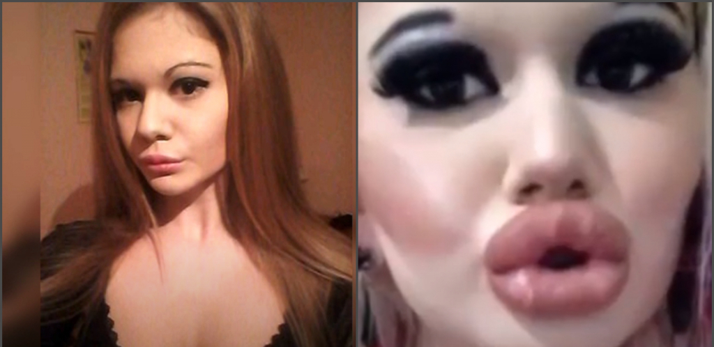 LEKARI SU JE UPOZORILI: Ako nastaviš s injekcijama usta će ti otpasti! (FOTO/VIDEO)