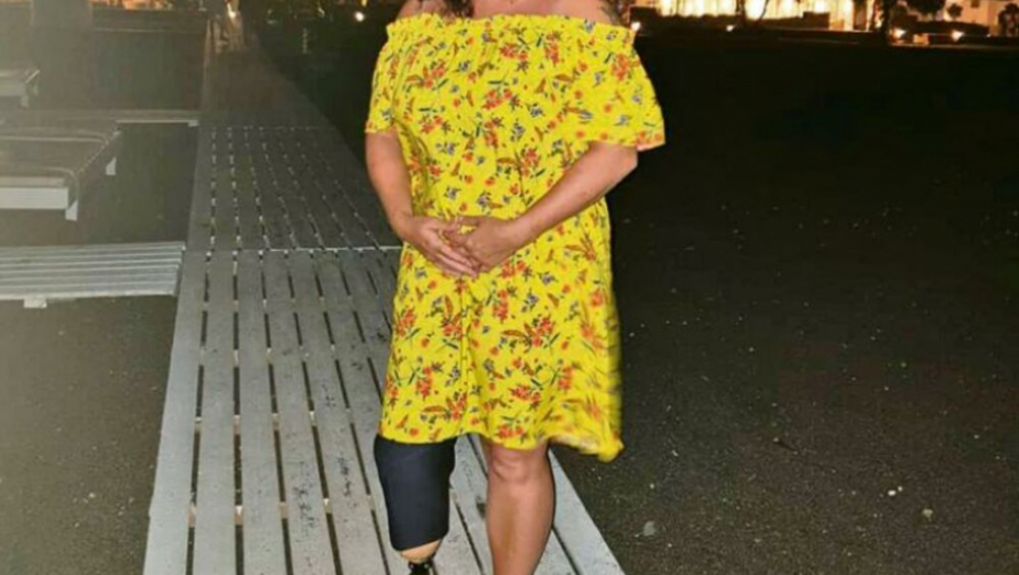 OSTALA BEZ NOGE ZBOG PARFEMA Godinama trpela nesnosne bolove, život joj postao PAKAO (FOTO)