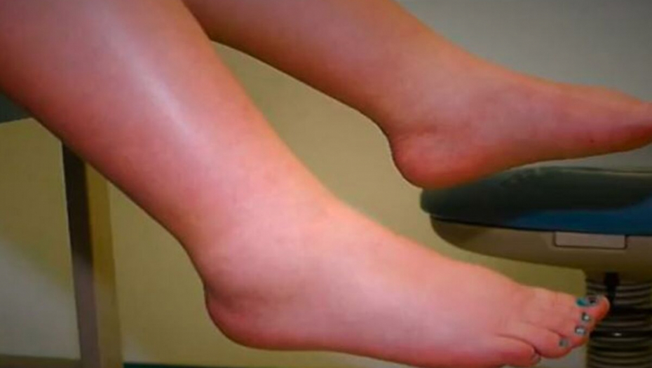 OTOK I BOL U STOPALIMA JE ZNAK OZBILJNE BOLESTI! Dr Radović objasnio zbog čega se voda nakuplja u nogama i kad se mora lekaru