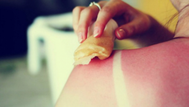 NAJBOLJI DOMAĆI RECEPTI ZA UBLAŽAVANJE OPEKOTINA OD SUNCA: Jeftinih melemi smiriće izgorelu kožu