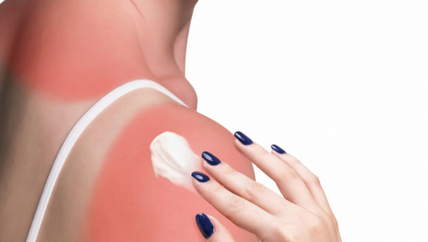 NAJBOLJI DOMAĆI RECEPTI ZA UBLAŽAVANJE OPEKOTINA OD SUNCA: Jeftinih melemi smiriće izgorelu kožu