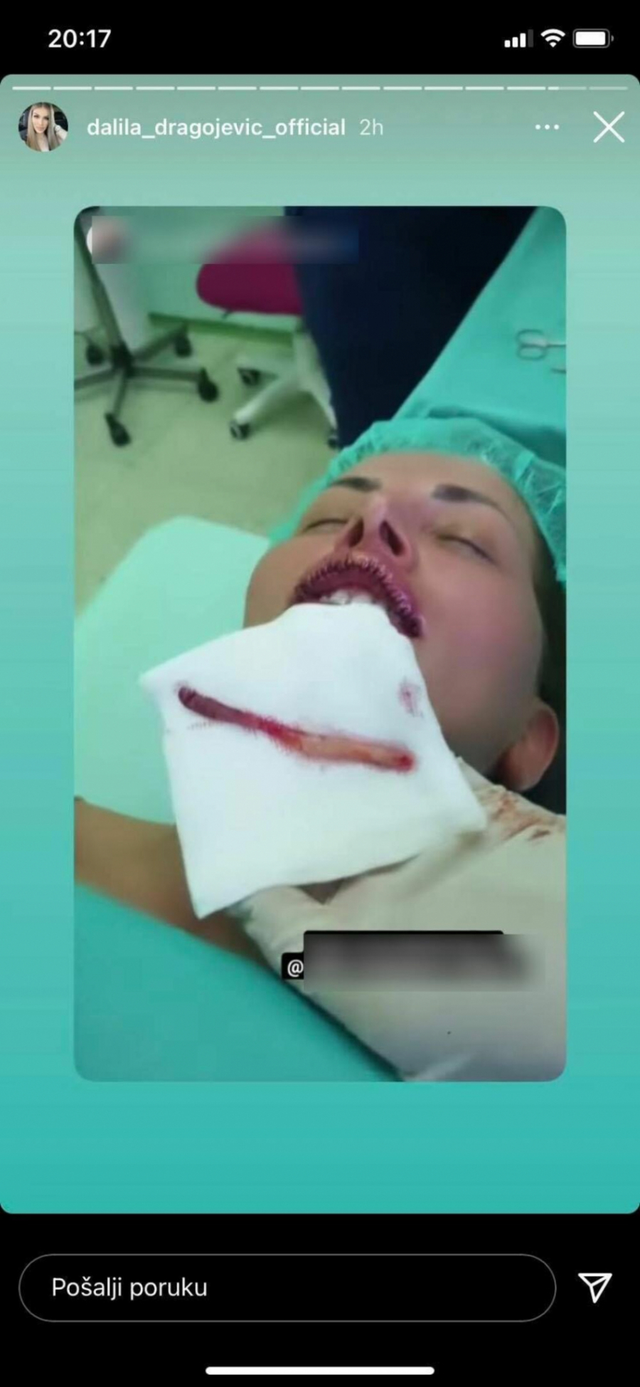 MISLILA SAM DA ĆU DA UMREM, NAJPRE SAM NAPIPALA KUGLICU Dalila prošla kroz pakao zbog silikona u usnama! (UZNEMIRIJUĆE FOTOGRAFIJE)