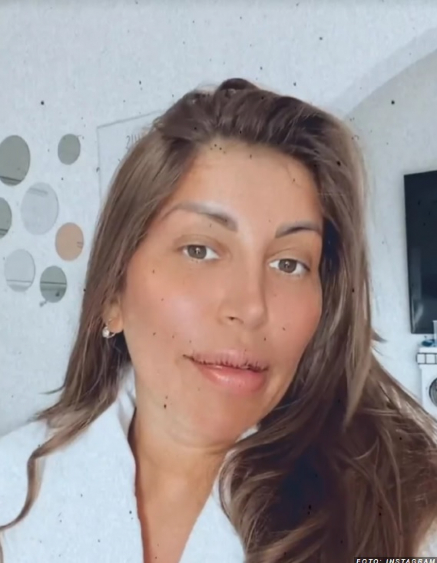 JEZIV PRIZOR Dalila objavila fotografiju usana nakon operacije, vise konci, a ona neprepoznatljiva (FOTO)