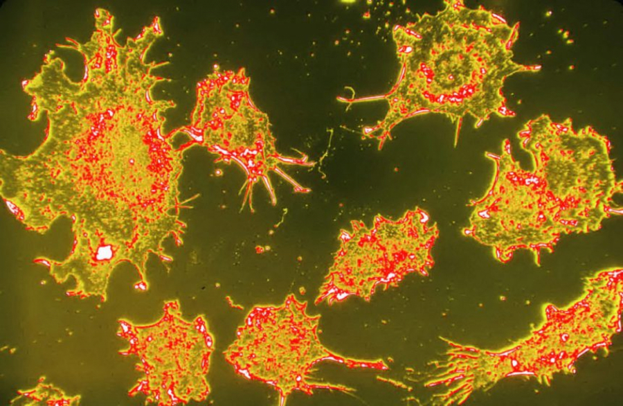 KISELOST ORGANIZMA KAO UZROK RAKA Ovaj efikasan napitak od četiri sastojka, čisti telo i vraća  pH  u ravnotežu