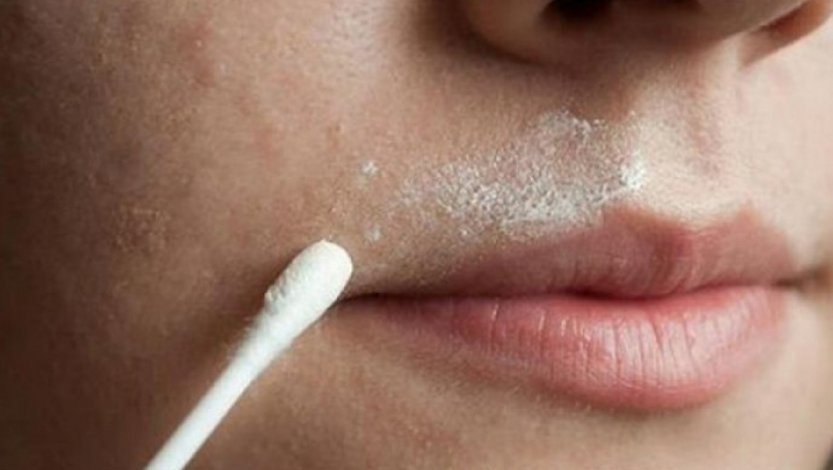 UKLONITE DLAČICE SA LICA SA SODOM BIKARBONOM Posle 2 tretmana će otpasti i neće ponovo rasti