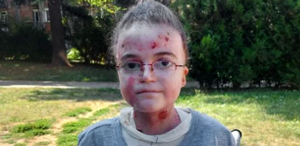 Anu boli svaki dodir, ali naša pomoć ublažiće njene muke: Pomažu samo specijalne gaze i stalna nega