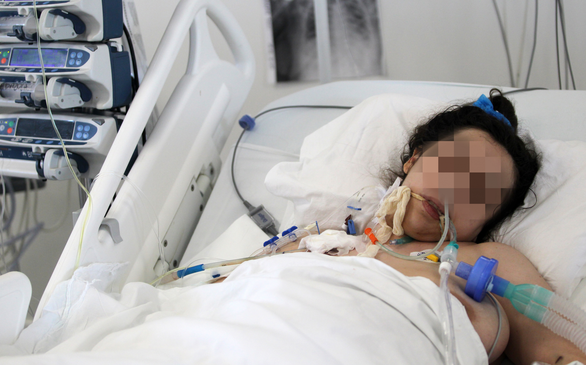 LEKARI OBELODANILI Zašto pacijenti priključeni na respirator završe fatalno