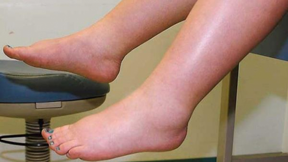 DOKTORI APELUJU: Ako primetite ove promene na nogama – u pitanju je srce, od brze intervencije često zavisi život