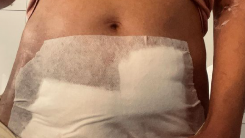 "PUNA SAM OŽILJAKA I TRAUMA"  Dariji su uklonili plod carskim rezom u 13. nedelji, njenu jezivu priču nećete  lako zaboraviti!