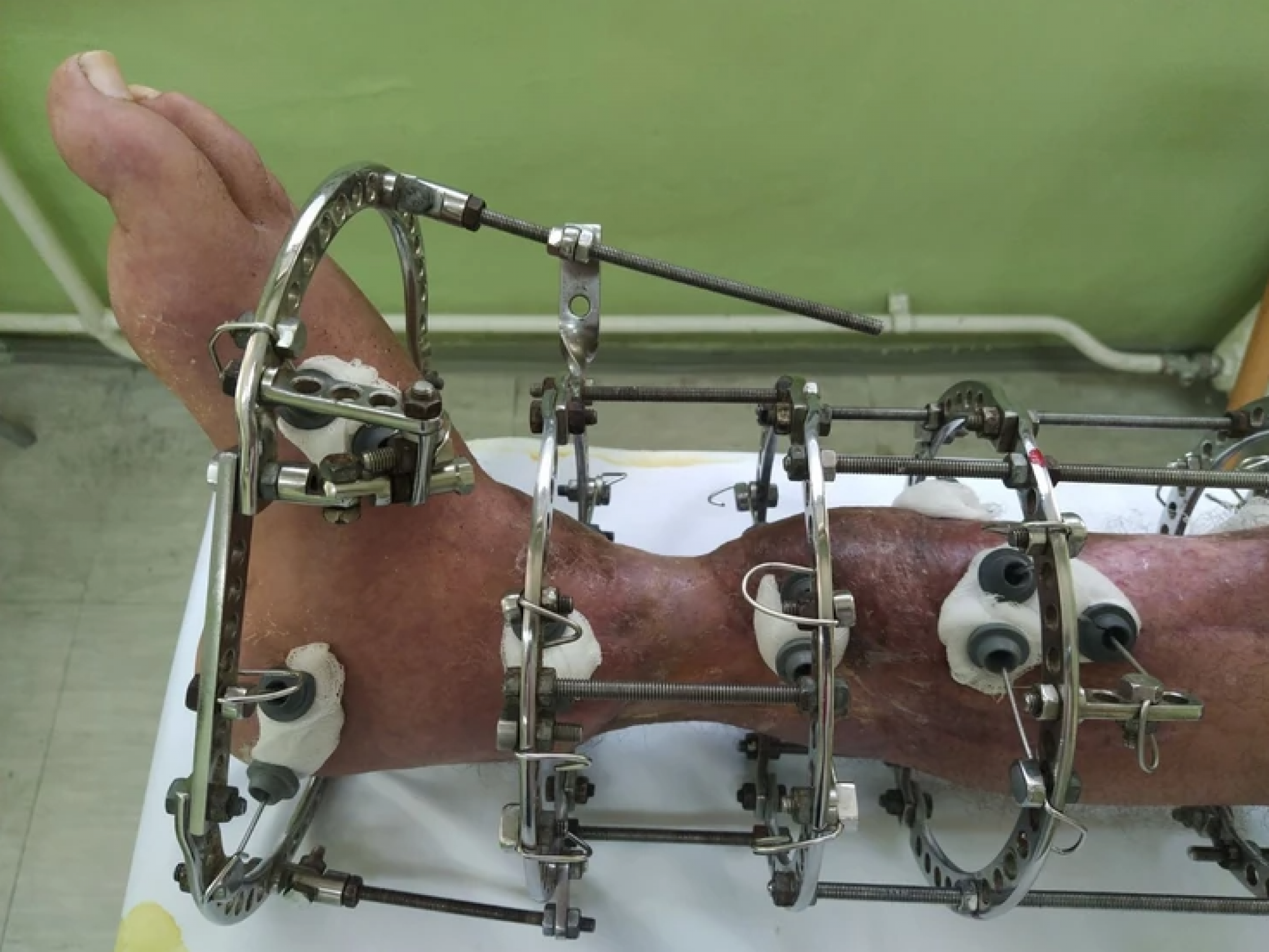 TEŽAK PODUHVAT KOJI JE ODLIČNO PROŠAO Dragan je umalo ostao bez noge, ali su dr Radivojčević i njegov tim uzeli stvar u svoje ruke! (UZNEMIRUJUĆE FOTOGRAFIJE)