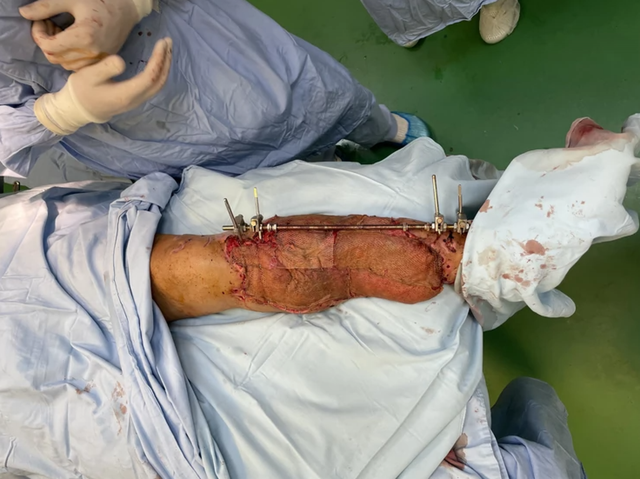 TEŽAK PODUHVAT KOJI JE ODLIČNO PROŠAO Dragan je umalo ostao bez noge, ali su dr Radivojčević i njegov tim uzeli stvar u svoje ruke! (UZNEMIRUJUĆE FOTOGRAFIJE)