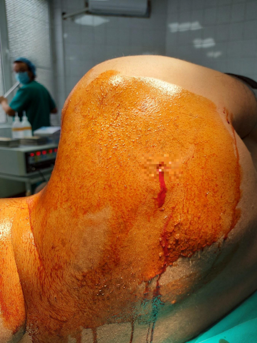 UZNEMIRUJUĆE FOTOGRAFIJE Jeziva rana od metka ROSU, Srbin se bori za život