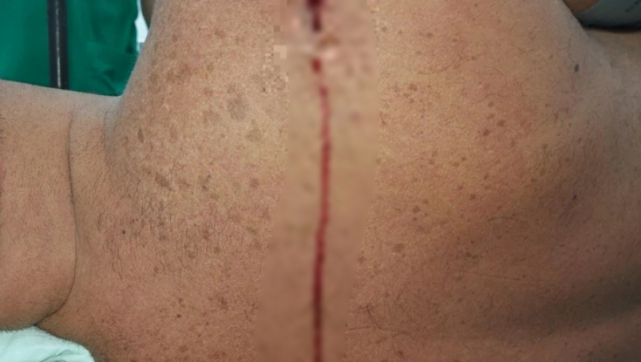 RANJENI SRBIN STABILNO POSLE OPERACIJE Ukupno 10 povređenih