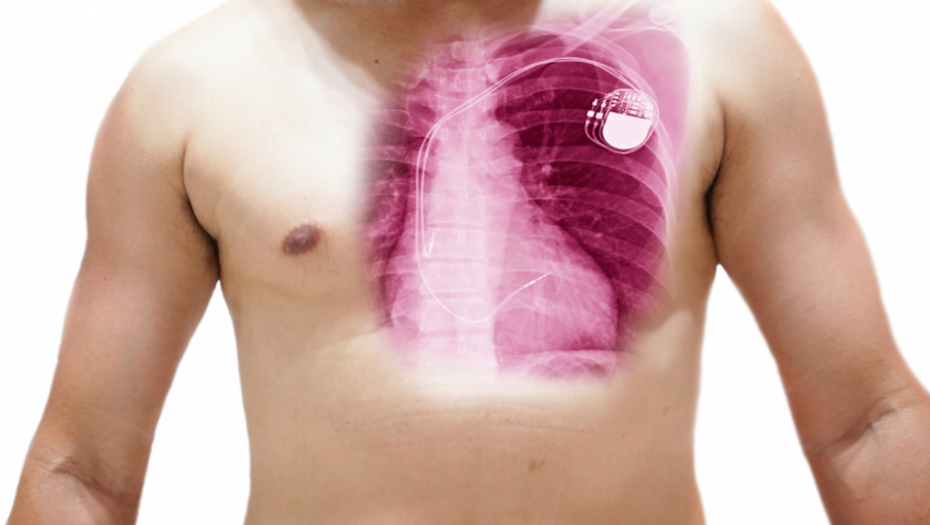 Trajno rešavanje srčanih aritmija