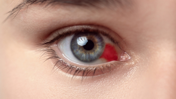 OBRATITE PAŽNJU: Ako vam pukne kapilar u oku uz ove simptome, pod hitno se morate javiti lekaru!
