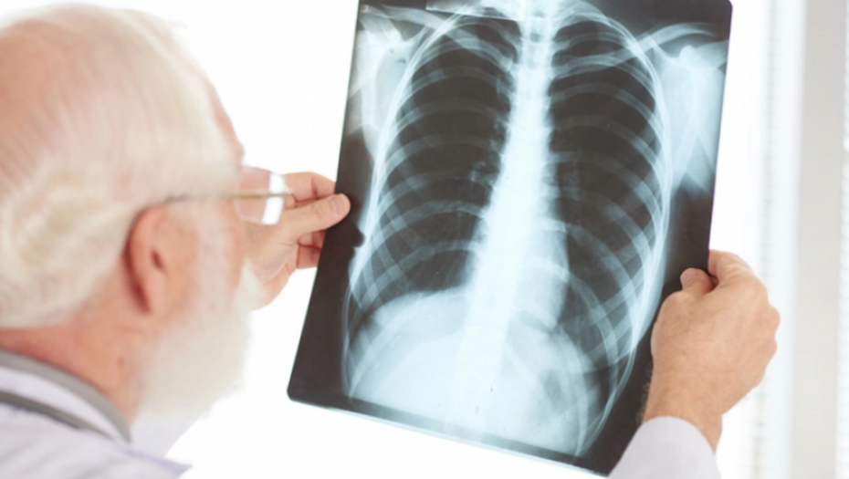 Srbija prva na Zapadnom Balkanu uvela skrining program za rano otkrivanje raka pluća