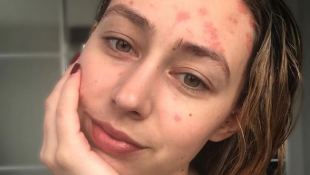 SA SAMO 18 GODINA ŽIVOT JOJ SE OKRENUO NAOPAČKE: Već šest godina se bori sa bolnom bolešću od koje pati samo tri odsto populacije