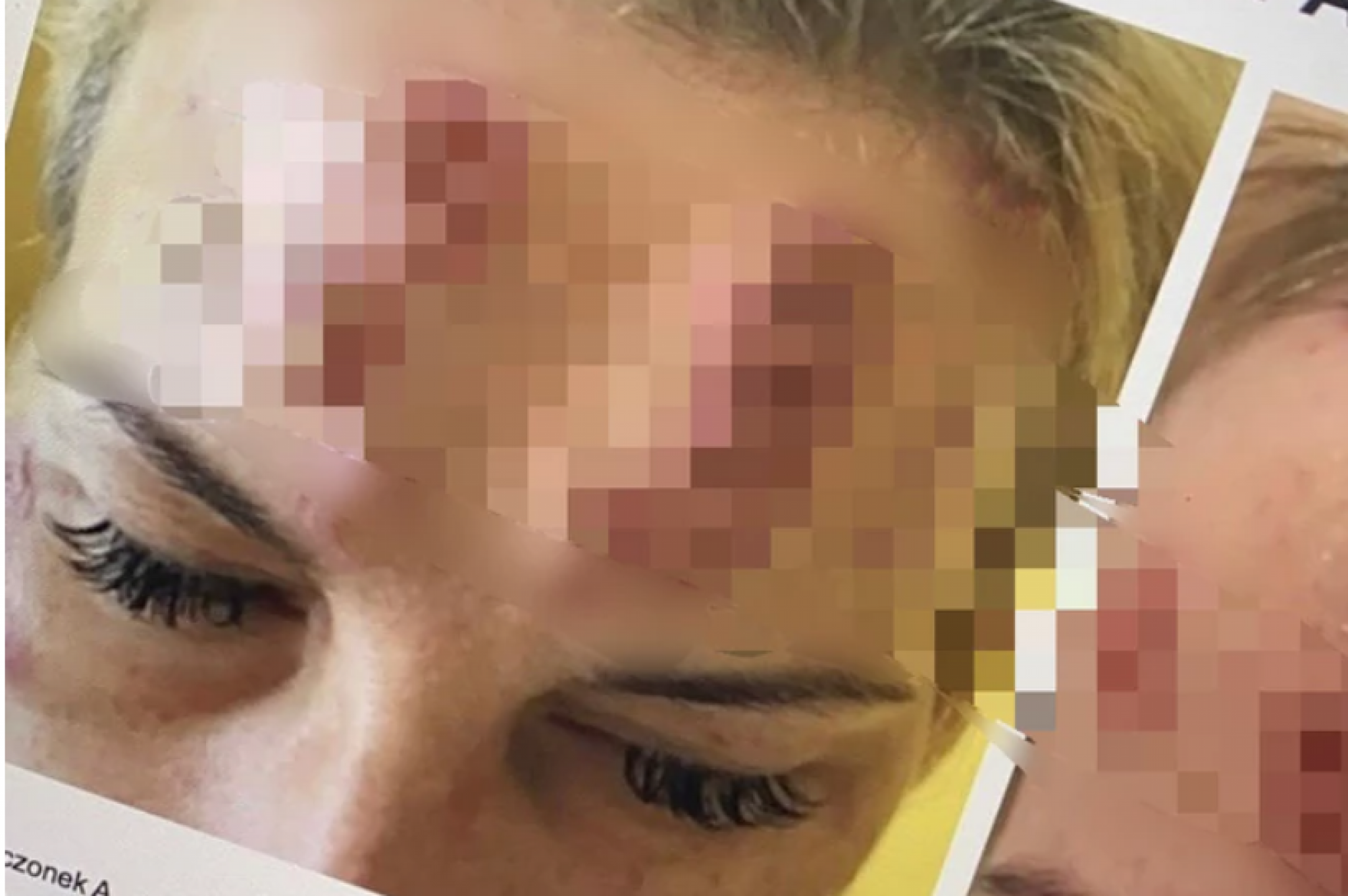 KINESKI BOTOKS PRAVI KRATERE NA LICIMA SRBA Nadrilekari se obrazovali na Jutjub kanalima i kupili serum na crnom tržištu, pa krenuli u akciju