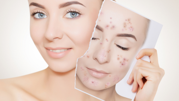 POTPUNO PRIRODNO Hilda (17) otkrila metodu uklanjanja akni sa samo dva sastojka iz vašeg doma