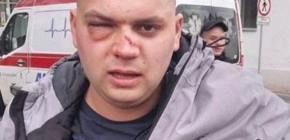 Žuti batinaši unakazili čoveka jer je hteo slobodno da se kreće u svojoj Srbiji! (FOTO)