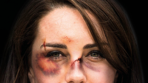 ZASTRAŠUJUĆI PRIZOR: Fotografija pretučene Kejt Midlton šokirala svet, šta se dešava?