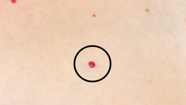 DA LI IMATE OVE CRVENE TAČKICE PO TELU? Najčešće su bezopasne, ali mogu da ukažu i na loše stanje jednog bitnog organa!