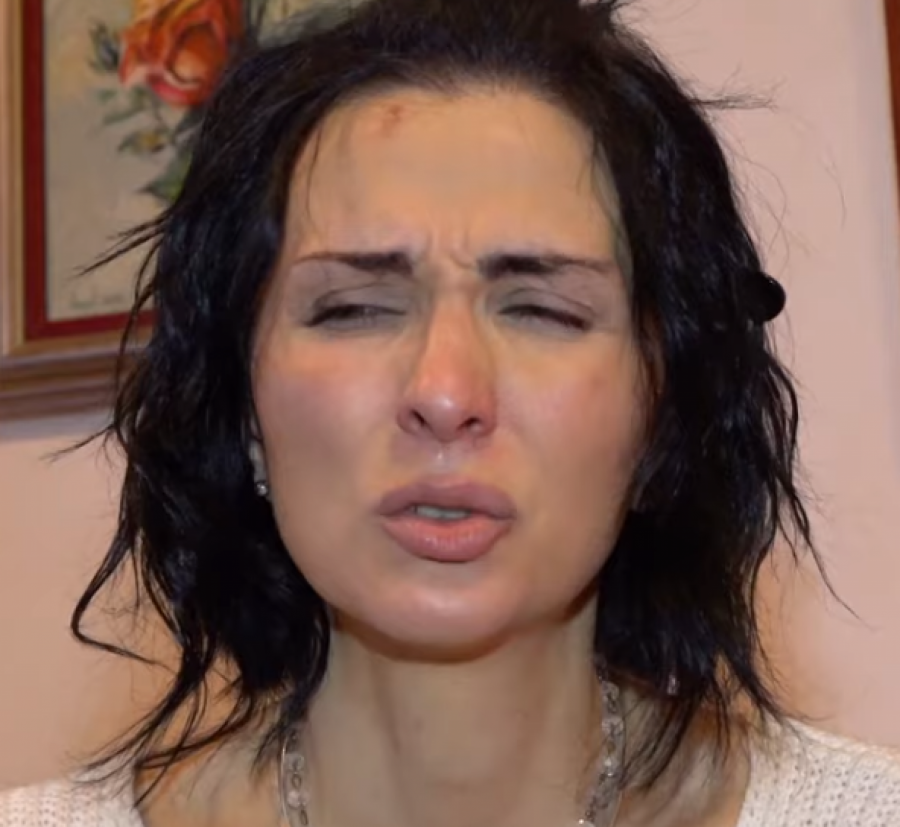 AMPUTIRALI SU JOJ NOGU I ODSTRANILI DOJKU! Potresna ispovest bivše učesnice rijalitija o teškoj borbi i patnji: Želela sam da živim