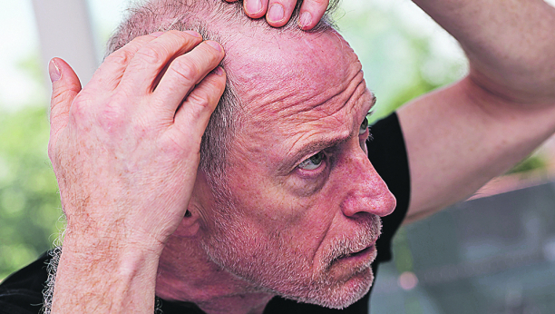 IMATE IH U KUĆI Prirodni lekovi protiv ćelavosti