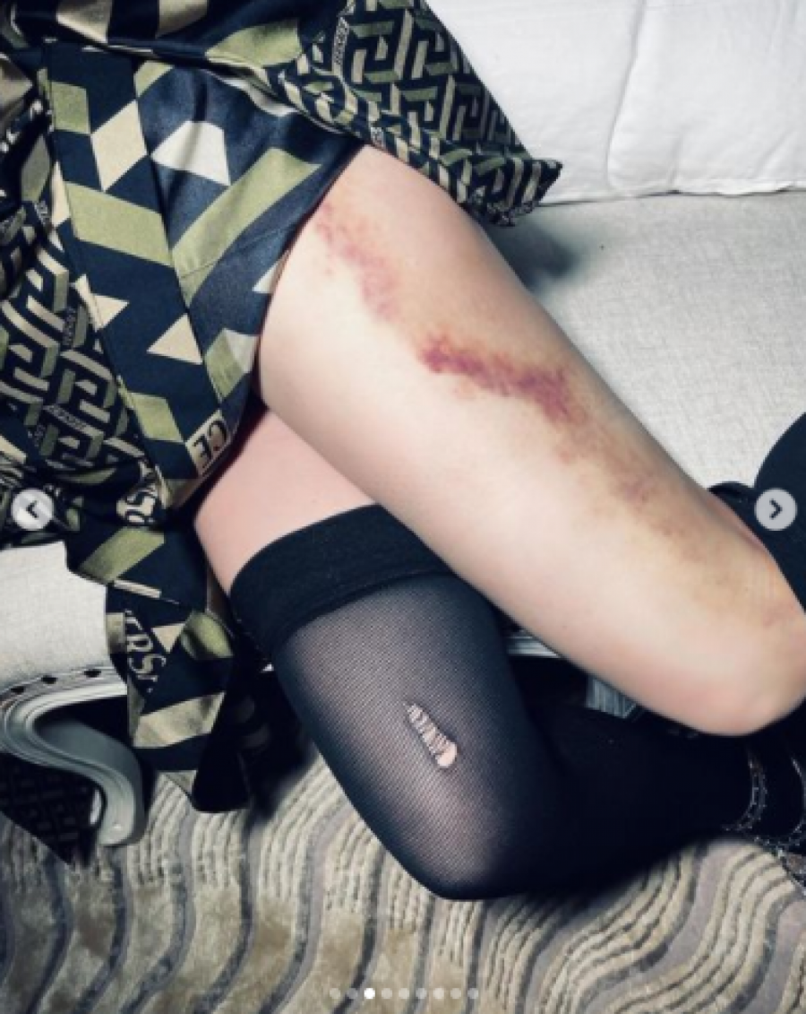 MADONA POKAZALA ZASTRAŠUJUĆE PODLIVE! Pevačica uplašila sve: Ko te je povredio? (FOTO)