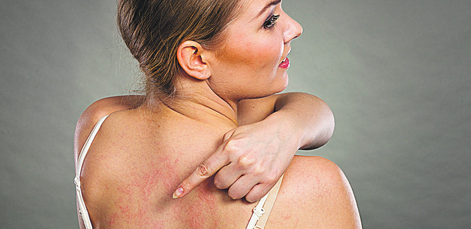 DVA SIMPTOMA SU KLJUČNA Da li ste alergični na zimu?