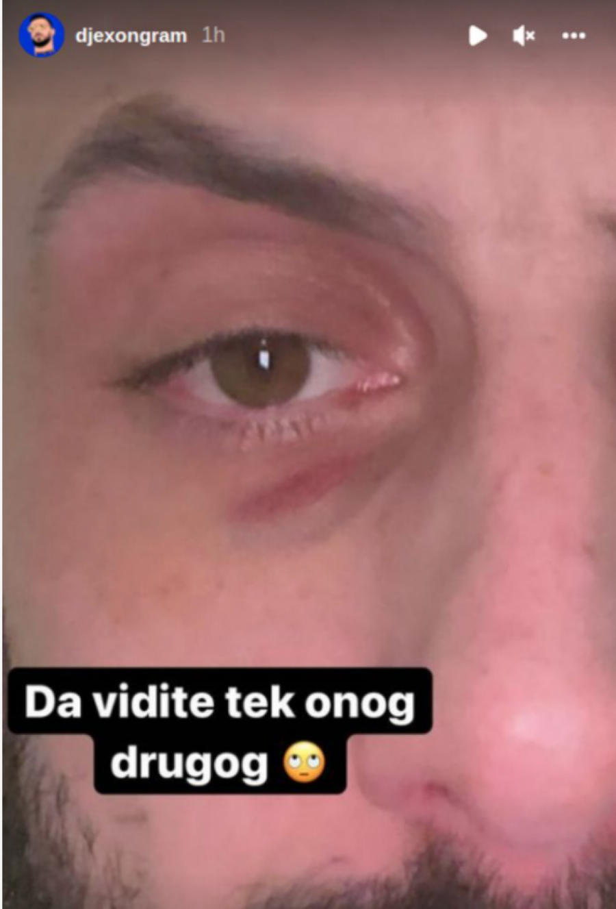 ĐEKSON POVREĐEN?! Pokazao zabrinjavajuću modricu, komenatri pljuštali, a evo šta se zapravo dogodilo!