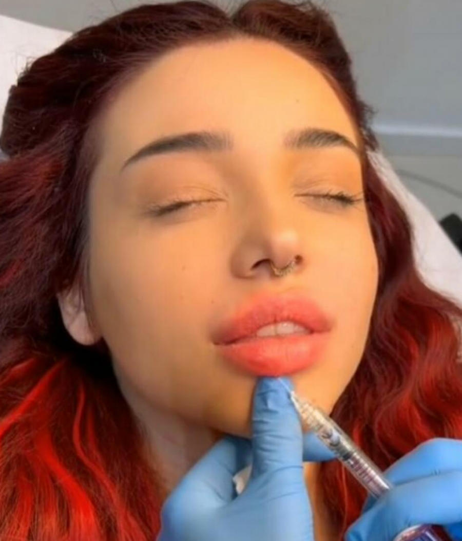 BRESKVICA NAPUMPALA USNE! Snimak iz salona isplivao na mrežama, a ovo je krajnji rezultat!