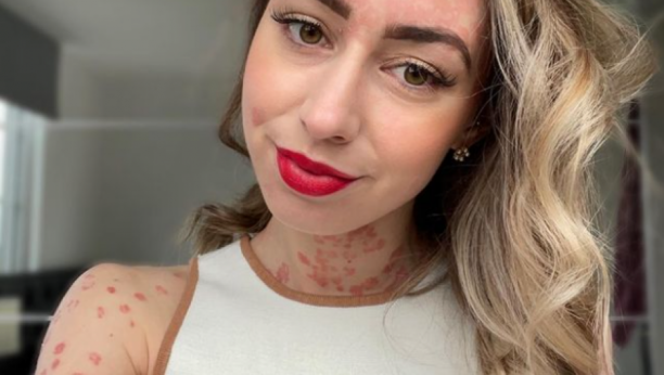 DA LI JE PSORIJAZA PRENOSNA?