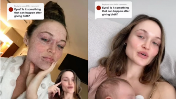 "NISAM SMELA DA SE POGLEDAM U OGLEDALO" Jelena pokazala zastrašujuću pojavu na licu nakon porođaja