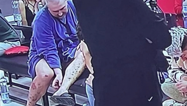 POTRESNE SLIKE Miki Đuričiću rane se počele otvarati i po glavi, doktori otkrili sve o ovoj neizlečivoj bolesti