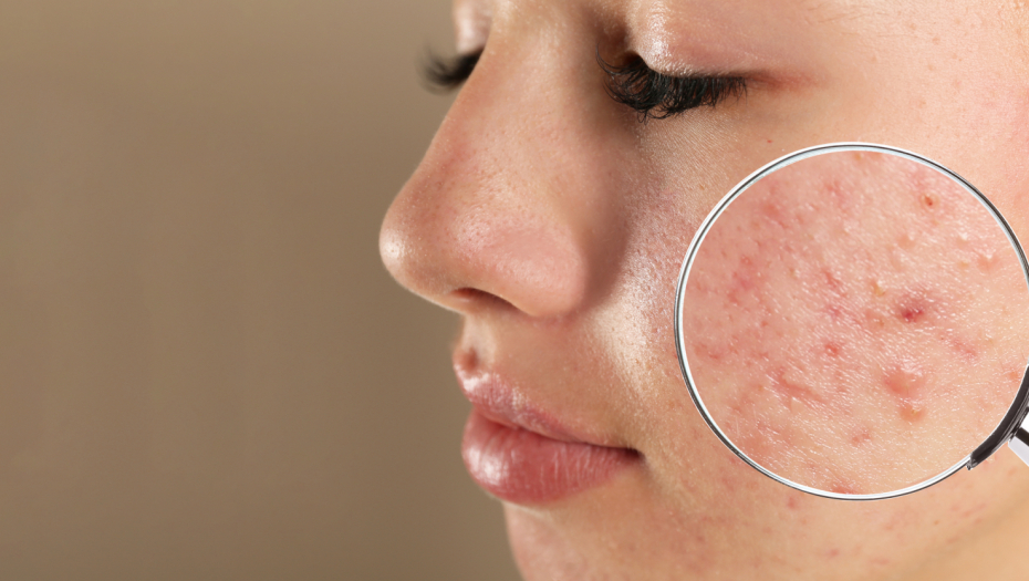 KORONA OSTAVLJA POSLEDICE NA KOŽI Među posledicama preležanog kovida može biti i ovo