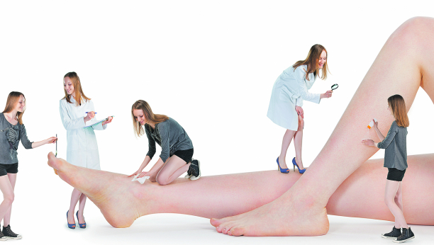 Limfedem - oboljenje koje narušava kvalitet života i ne može se izlečiti