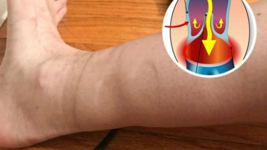 UJUTRO JEDVA OBUVATE CIPELE Domaći prirodni lek protiv oticanja nogu