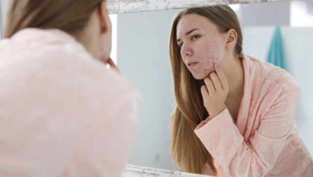 Dermatolozi upozoravaju: Ovo je uzrok pojave bubuljica na samo jednoj strani lica