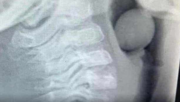 DEČAK (6) ZAVRŠIO U HITNOJ Šokantan rendgenski snimak pokazuje šta je progutao i počeo da se guši