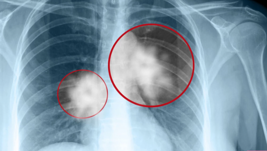 KARDIOLOG DR ARSEN RISTIĆ OTKRIVA Nije krvni pritisak, ova vrsta hipertenzije je najopasnija, drastično skraćuje život