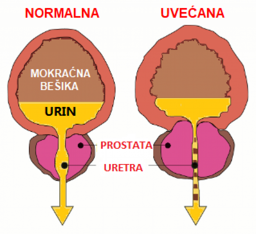 UROLOZI UPOZORAVAJU Ovo je prvi simptom da vam se prostata uvećava?