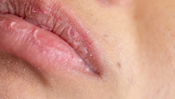 SIMPTOMI SRČANIH OBOLJENJA VIDE SE NA LICU Ako imate ovakve usne, odmah se javite kardiologu