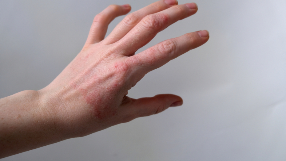 PRIRODNI LEK ZA EKCEM: Iskoristite bundevu za negu kože