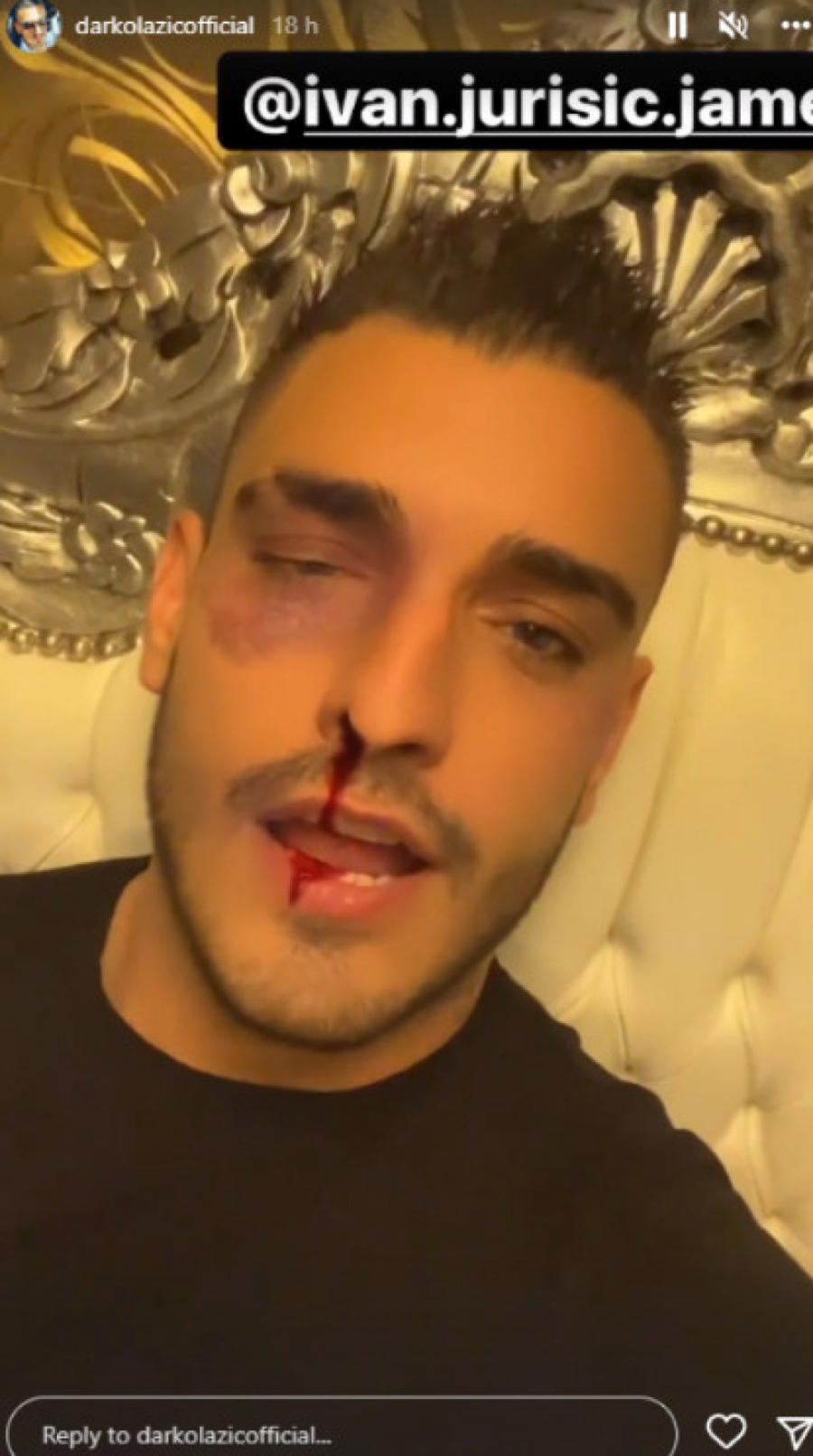 PRETUČEN DARKO LAZIĆ? Pevač sav u modricama, oglasio se putem društvenih mreža (FOTO)