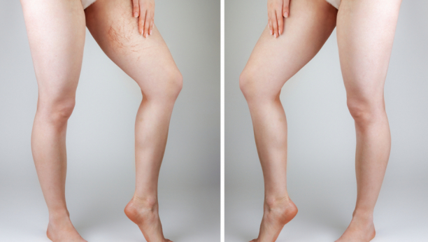 STARI TRIK KOJI ZLATA VREDI Evo zašto žene masovno mažu butine sirćetom, rezultati će vas iznenaditi