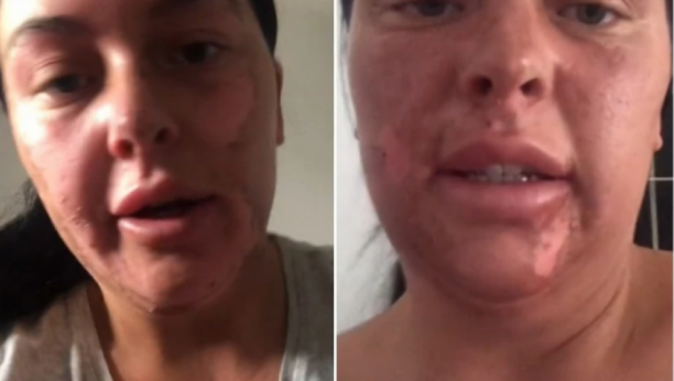 ZBOG JEDNE GREŠKE U KUHINJI HITNO ZAVRŠILA U BOLNICI Žena je dobila jezive opekotine po celom licu, a sada se gorko kaje!