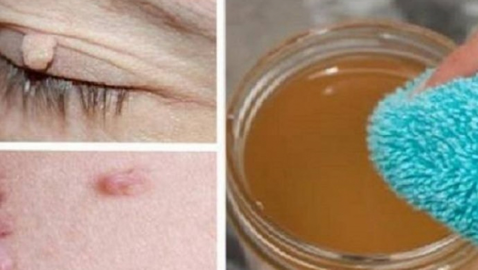 NAJJEFTINIJI I NAJEFIKASNIJI LEK Imamo ga svi u kući, a skida fibrom ili bradavice veoma lako