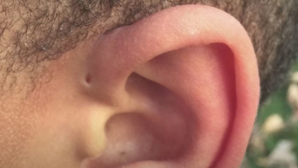 ZNATE LI ŠTA ZNAČI RUPICA NA UVETU? Prava je retkost, uopšte ne bi treblo da se nalazi na tom mestu, postoji stručno objašnjenje